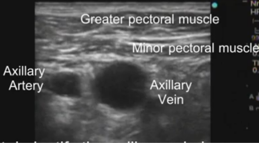 Ultrasound of the pectoralis muscles, axillary artery and vein, and arterial branches