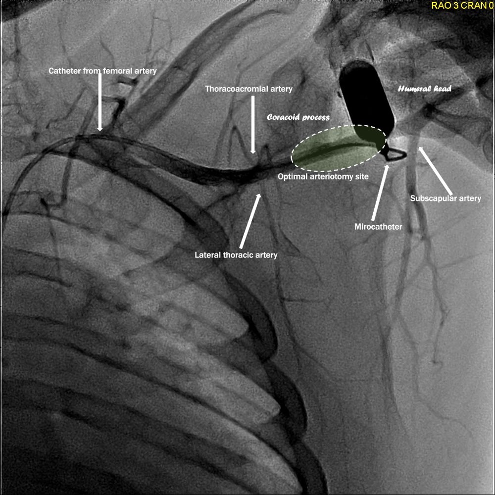 Angiogram showing an optimal axillary arteriotomy site