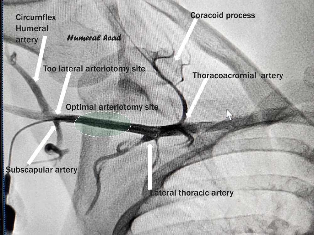 Angiogram showing a suboptimal, too distal axillary arteriotomy site
